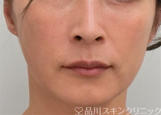 症例NO.27927のAFTER写真