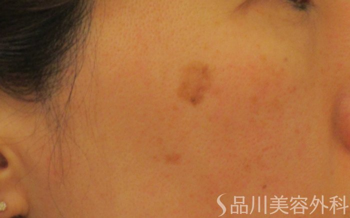症例NO.65374のBEFORE写真