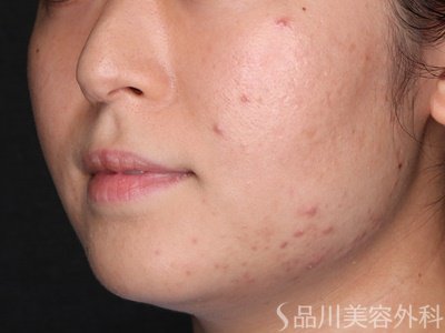 症例NO.75280のBEFORE写真