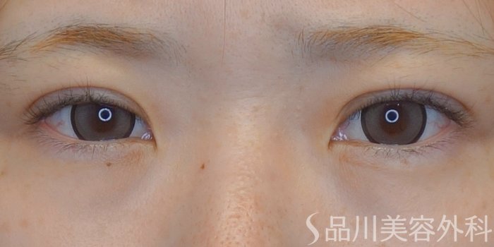 症例NO.73817のAFTER写真