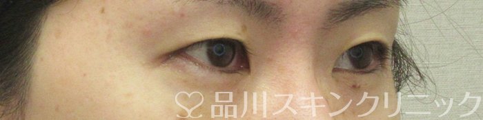 症例NO.73935のBEFORE写真