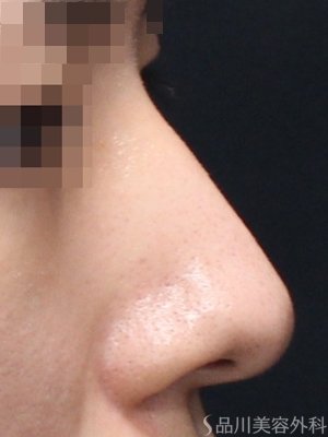 症例NO.75215のBEFORE写真