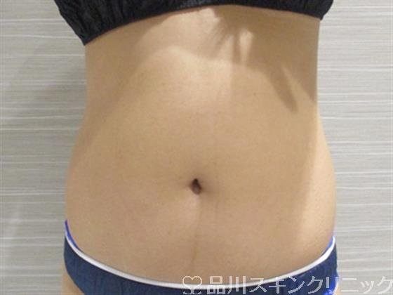 症例NO.34724のAFTER写真