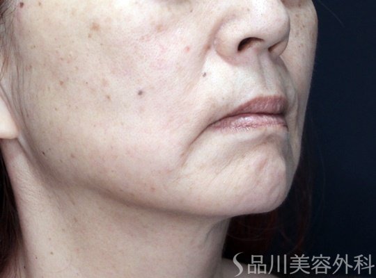 症例NO.70347のAFTER写真