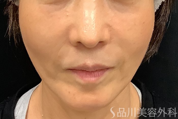 症例NO.71248のAFTER写真