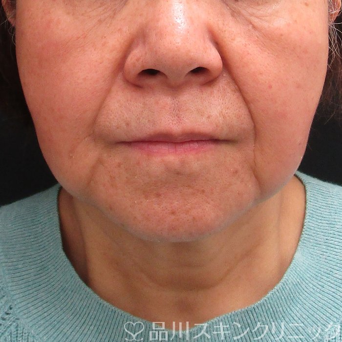症例NO.73804のBEFORE写真