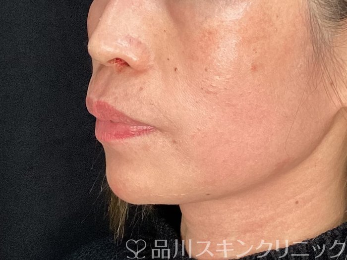 症例NO.72661のAFTER写真