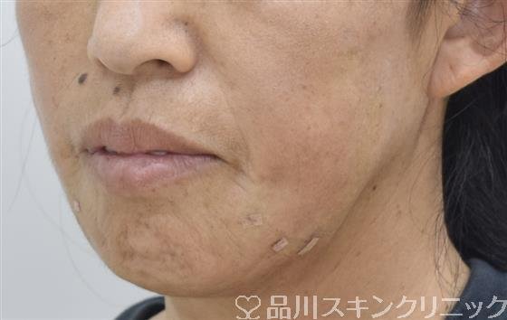 症例NO.43083のAFTER写真