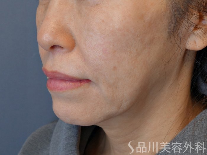 症例NO.73971のBEFORE写真