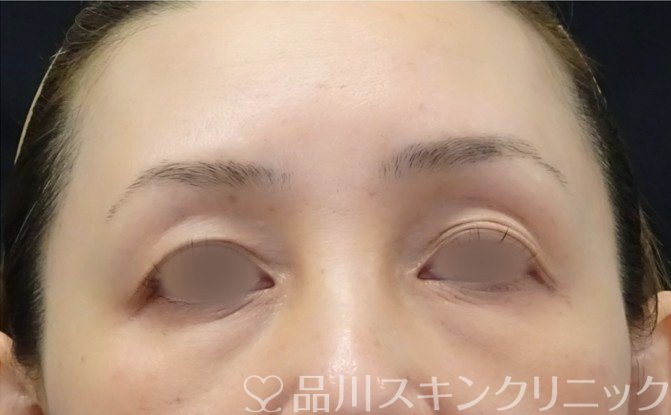 症例NO.71150のBEFORE写真