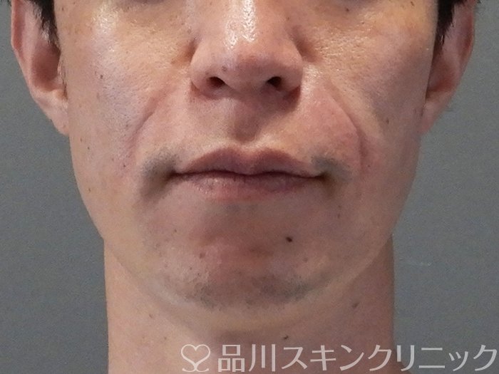 症例NO.70689のAFTER写真