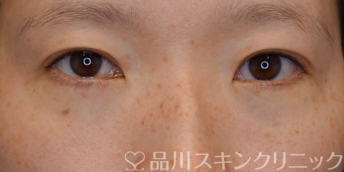 症例NO.73695のAFTER写真