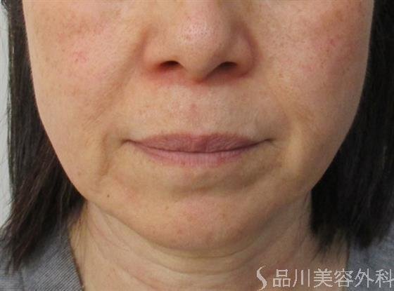 症例NO.53550のBEFORE写真