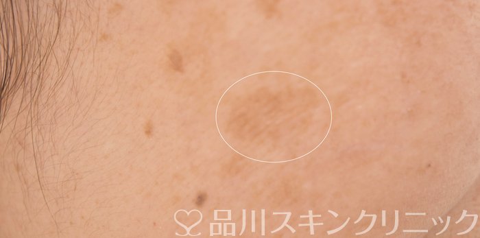 症例NO.64702のBEFORE写真