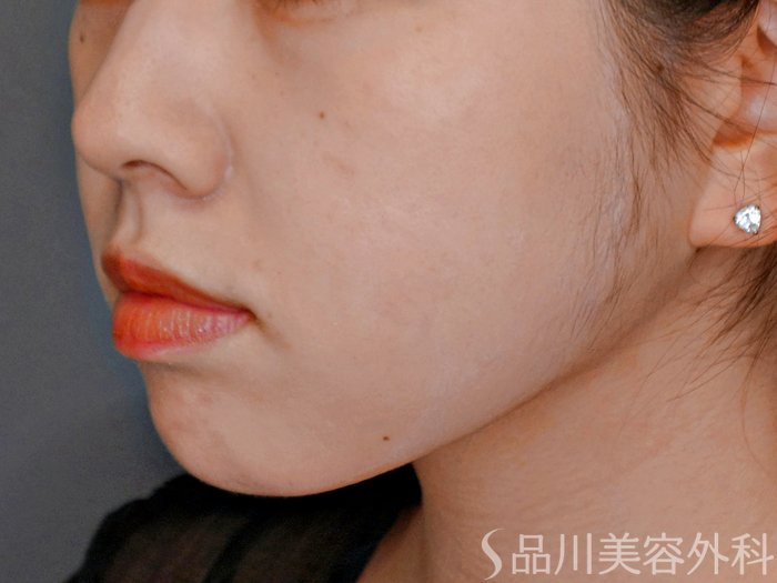 症例NO.73772のBEFORE写真