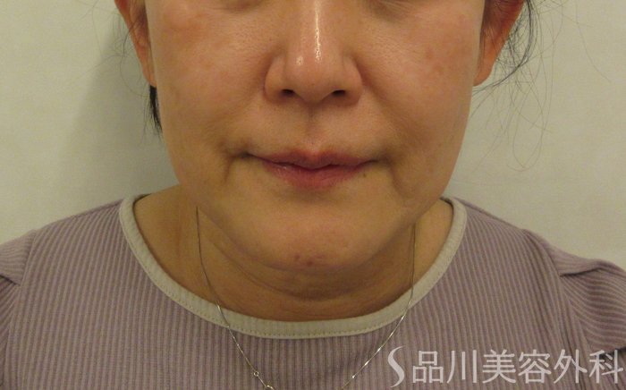 症例NO.72342のBEFORE写真