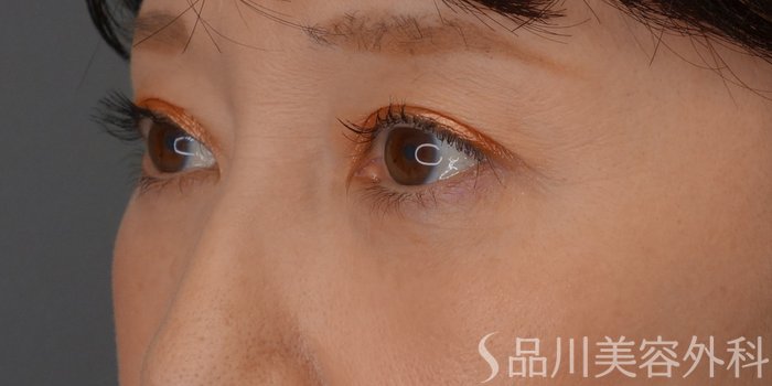 症例NO.75112のAFTER写真