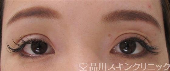 症例NO.42340のAFTER写真