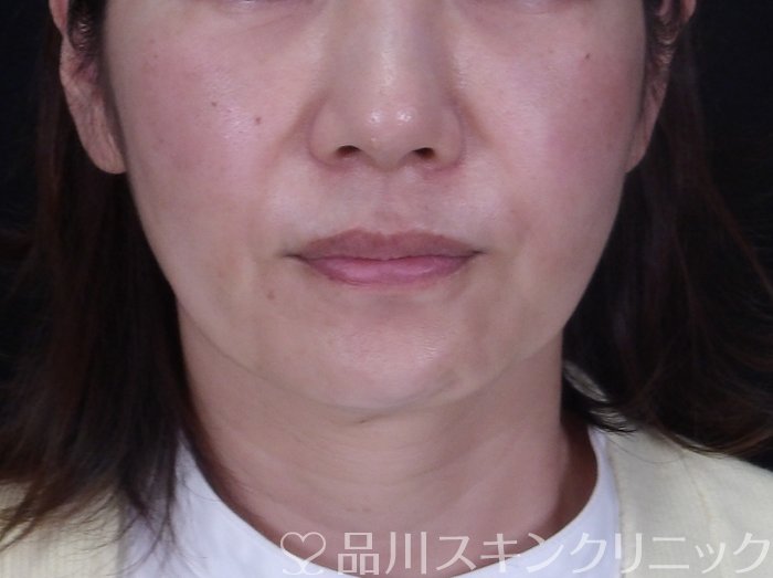 症例NO.72560のBEFORE写真