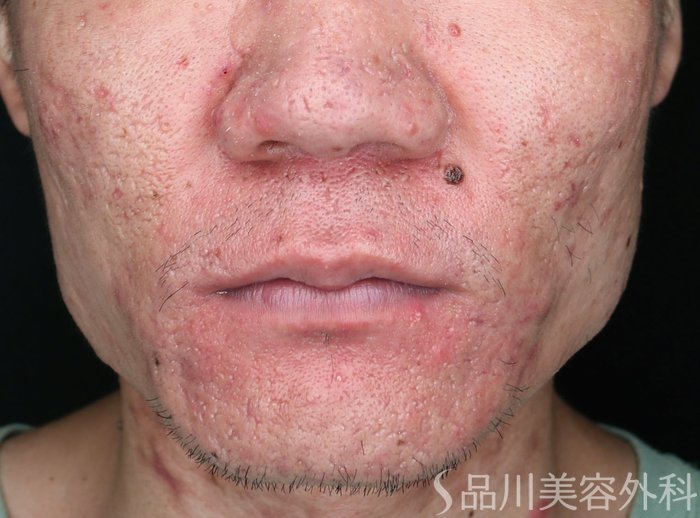 症例NO.74417のBEFORE写真