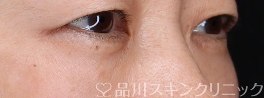 症例NO.74126のBEFORE写真
