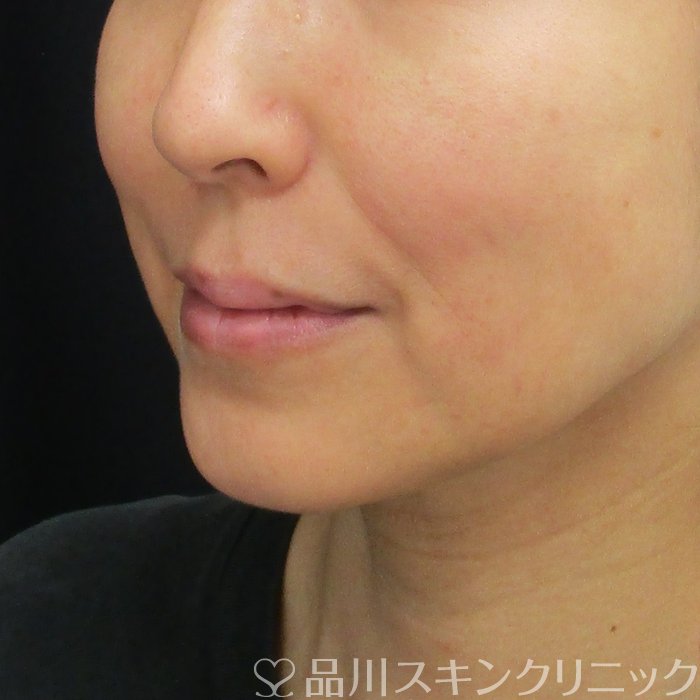 症例NO.74953のBEFORE写真
