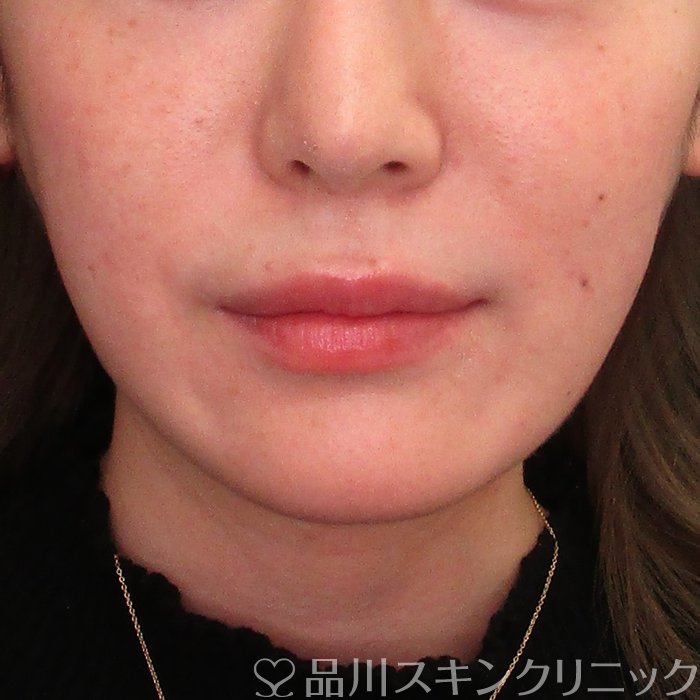 症例NO.73496のBEFORE写真