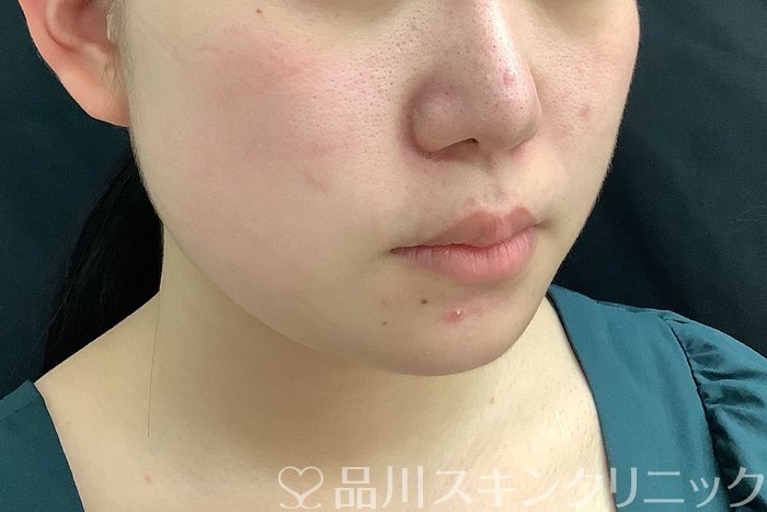 症例NO.69778のAFTER写真