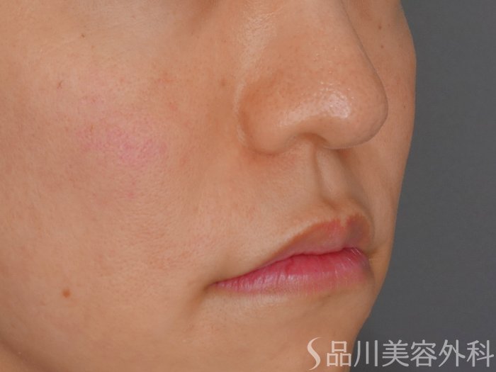 症例NO.72156のAFTER写真