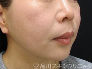 症例NO.74285のAFTER写真