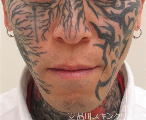 症例NO.26721のBEFORE写真
