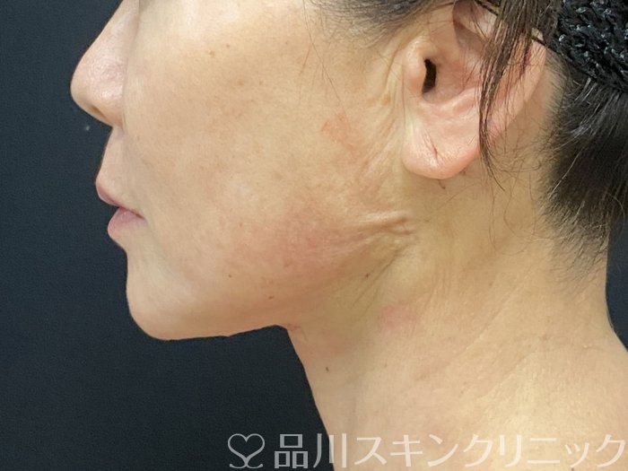 症例NO.74403のAFTER写真