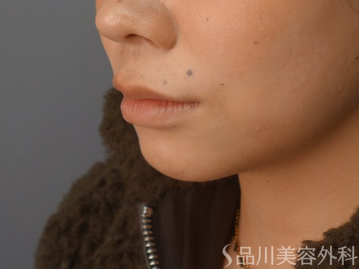 症例NO.72470のBEFORE写真