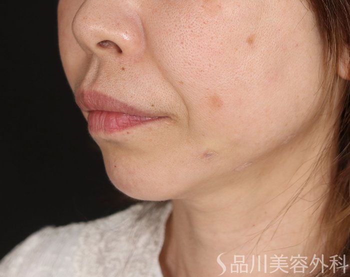 症例NO.72160のAFTER写真