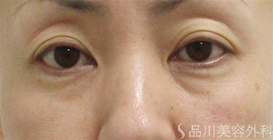 症例NO.55430のBEFORE写真