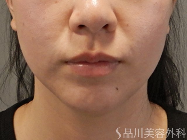 症例NO.71551のBEFORE写真