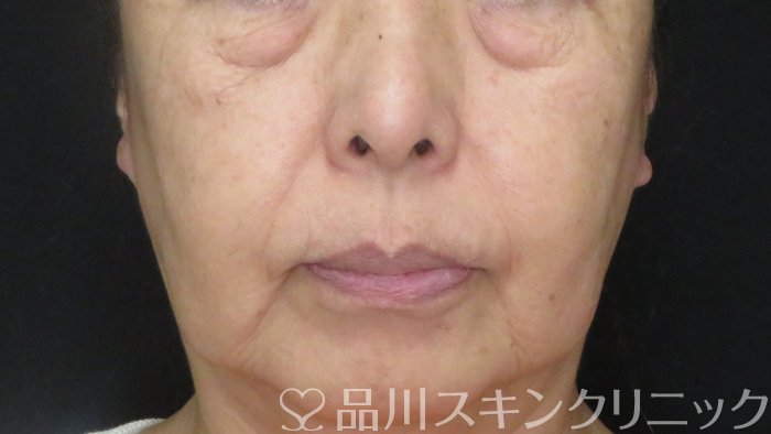 症例NO.71997のBEFORE写真