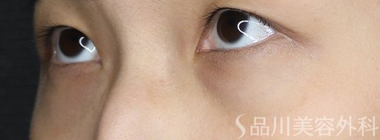 症例NO.73503のBEFORE写真