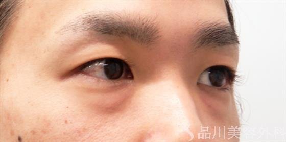 症例NO.54346のBEFORE写真