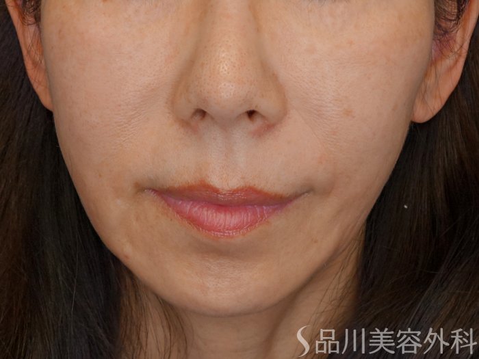 症例NO.73927のBEFORE写真
