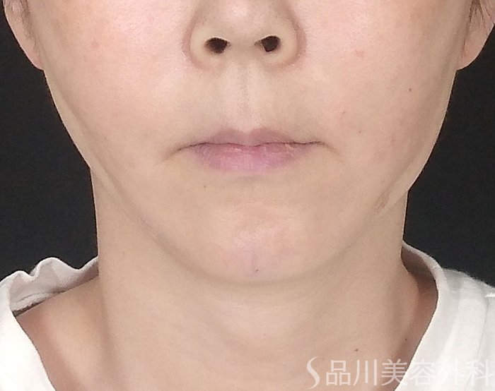 症例NO.65408のAFTER写真