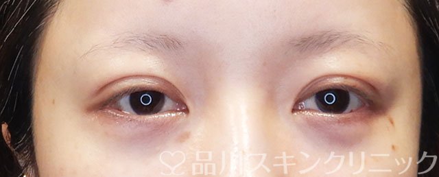 症例NO.74999のAFTER写真