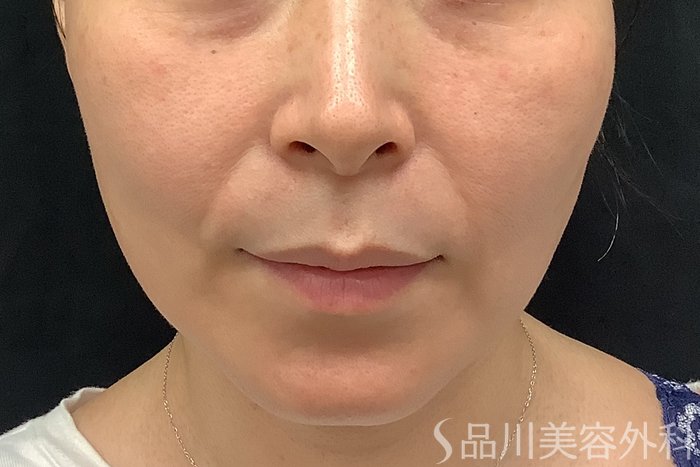 症例NO.71252のBEFORE写真