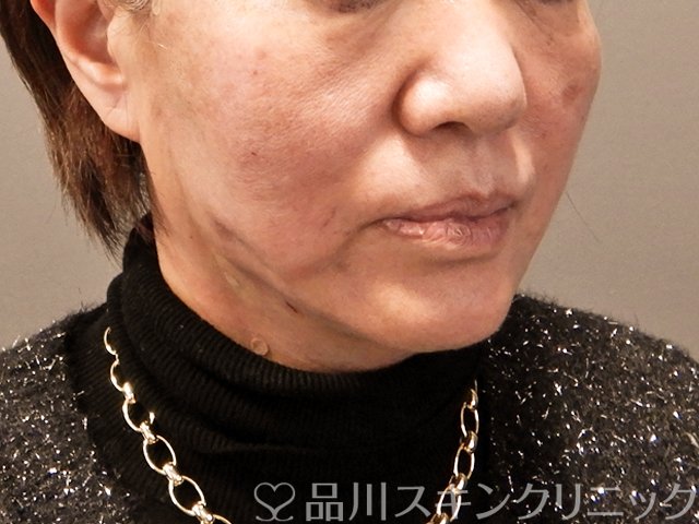 症例NO.69432のAFTER写真