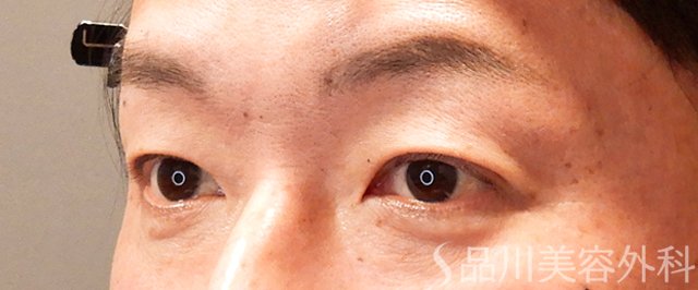 症例NO.69298のAFTER写真