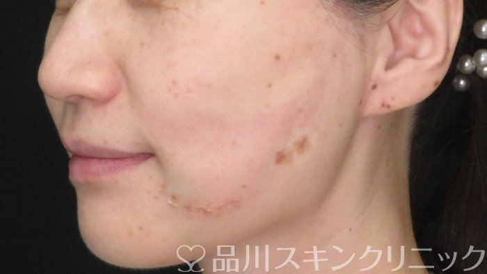 症例NO.70963のAFTER写真