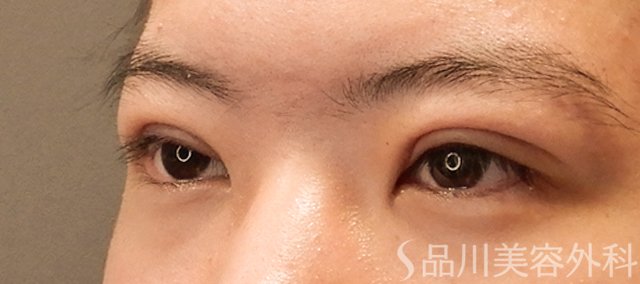 症例NO.72319のAFTER写真