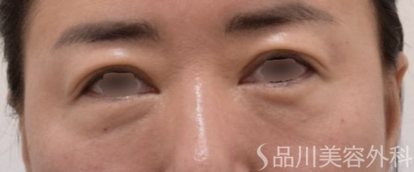 症例NO.71764のBEFORE写真