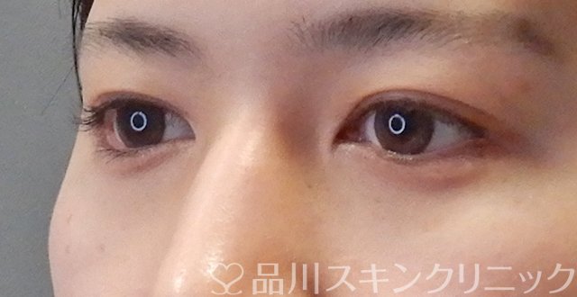 症例NO.67384のAFTER写真