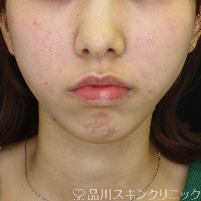 症例NO.65344のAFTER写真